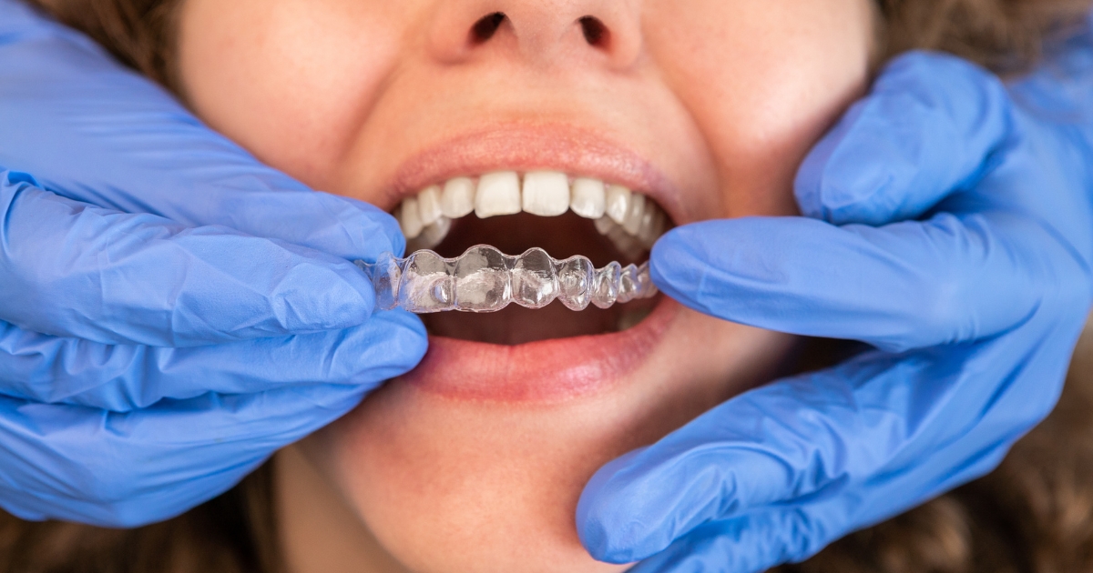 Invisalign Treatment: What to Expect During Your First Consultation?