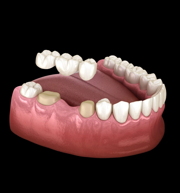 Dental Crowns and Bridges in Round Rock, TX - Moment Dental