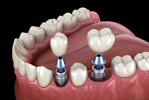Dental Implants in Round Rock, TX - Moment Dental
