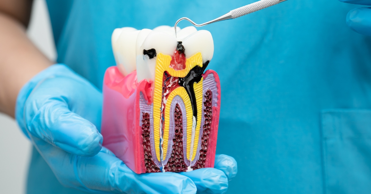 Signs You Might Need a Root Canal: How to Recognize the Symptoms