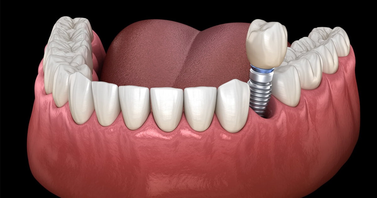 What to Expect After Dental Implant Surgery